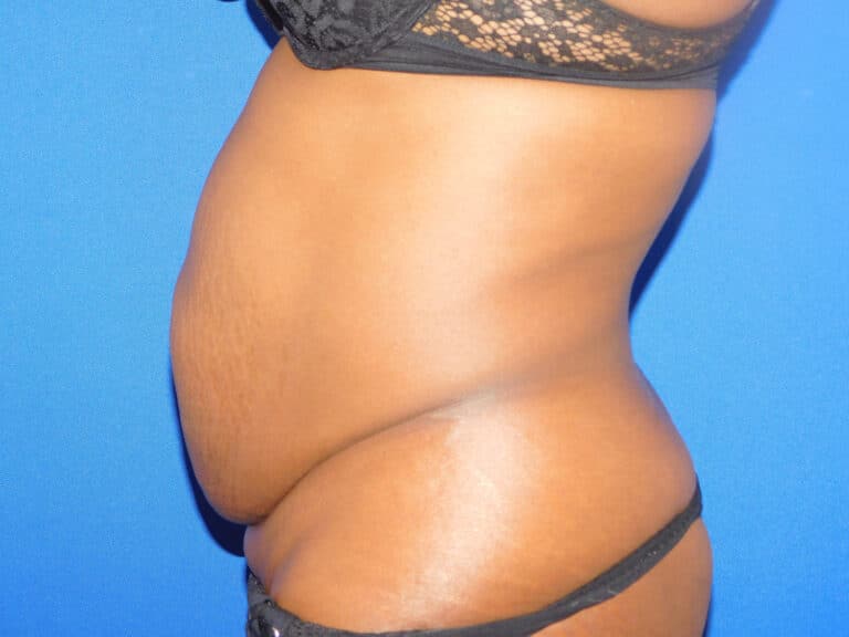 Before Image: Abdominoplasty - left-side