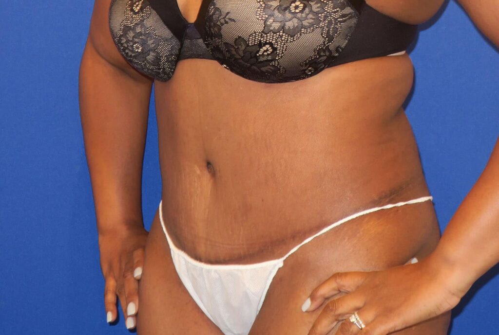 After Image: Abdominoplasty - left-front-oblique