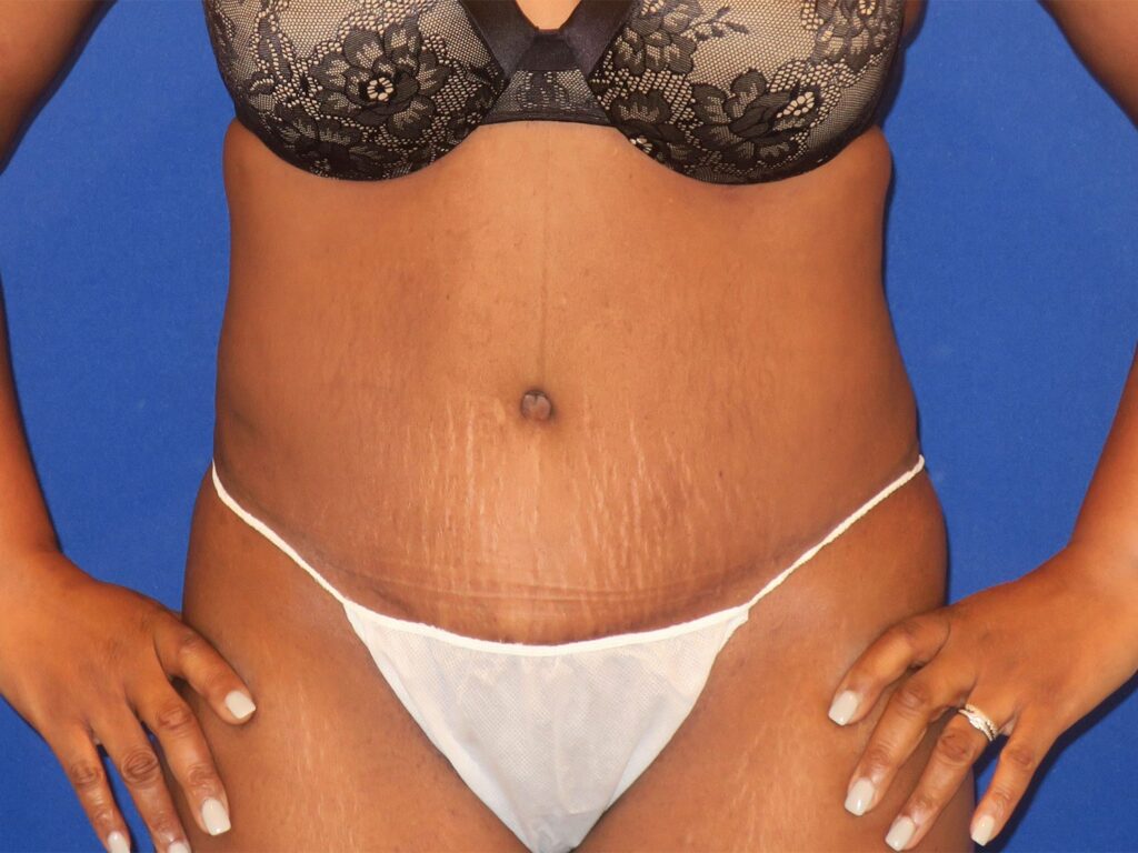 After Image: Abdominoplasty - front