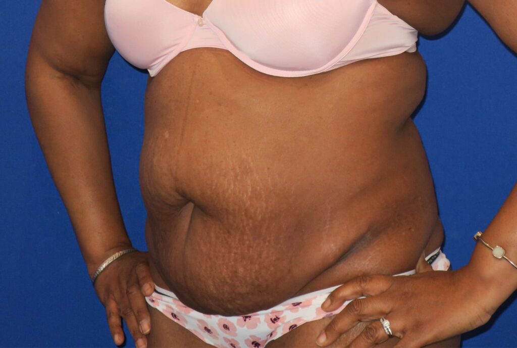 Before Image: Abdominoplasty - left-front-oblique