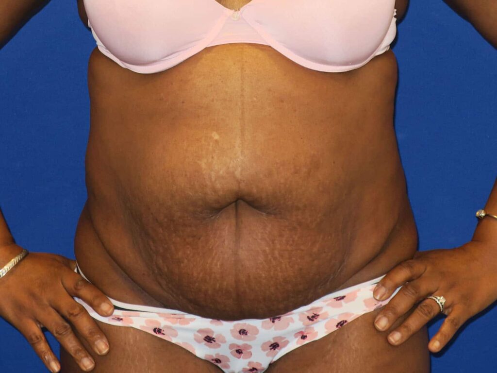 Before Image: Abdominoplasty - front
