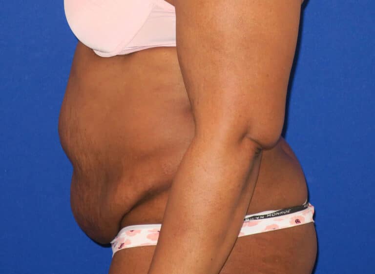 Before Image: Abdominoplasty - left-side