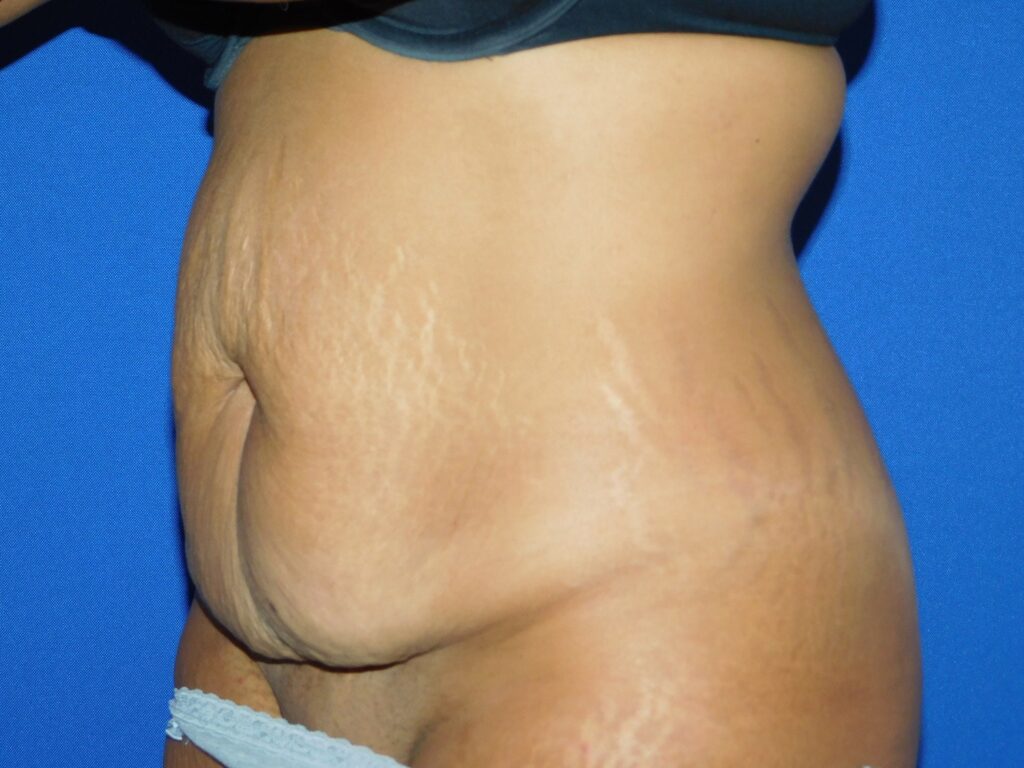 Before Image: Abdominoplasty - left-front-oblique