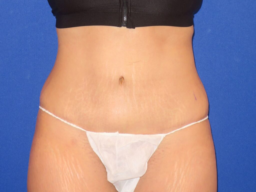 After Image: Abdominoplasty - front