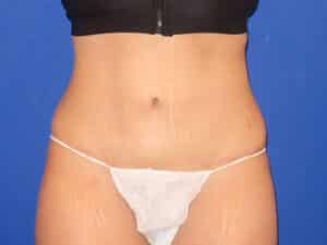 After Image: Abdominoplasty