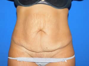 Before Image: Abdominoplasty