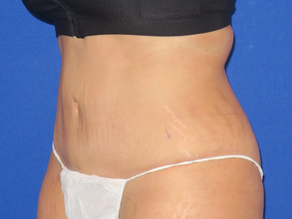 After Image: Abdominoplasty - left-front-oblique
