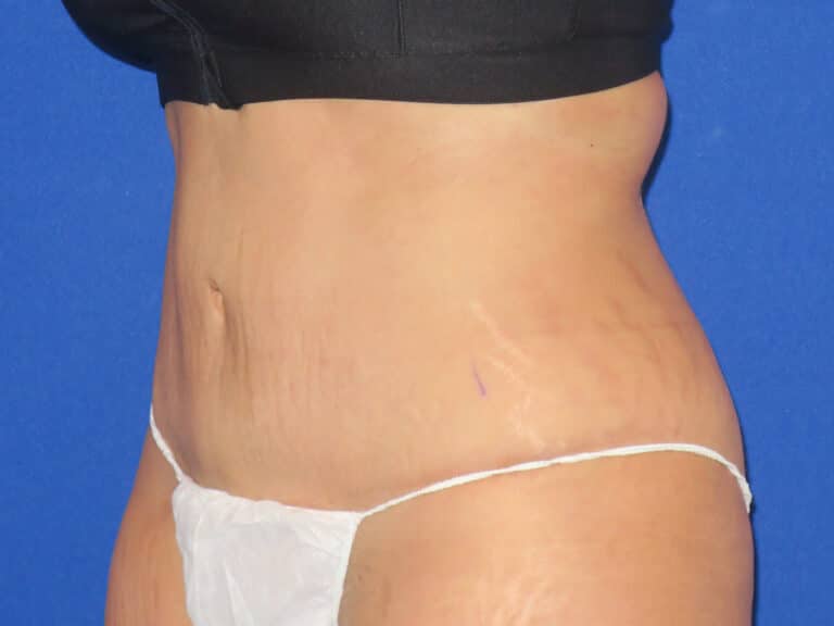 After Image: Abdominoplasty - left-front-oblique