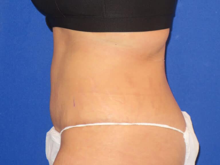 After Image: Abdominoplasty - left-side