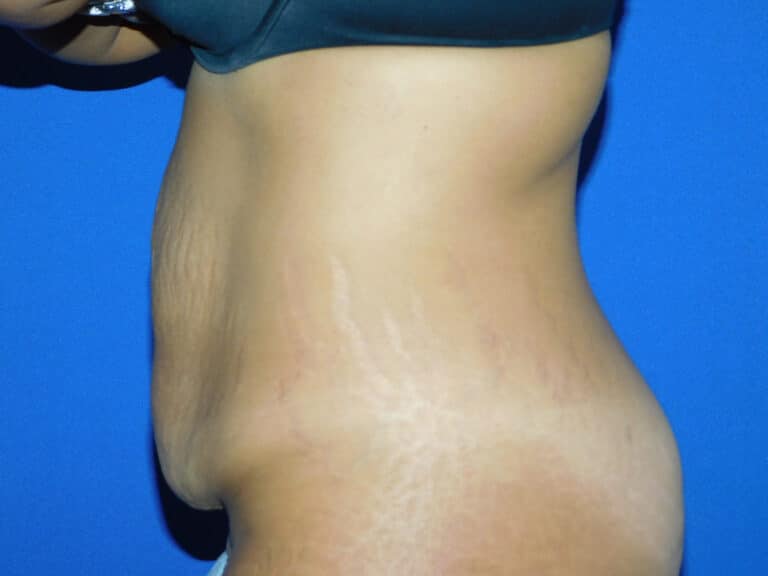 Before Image: Abdominoplasty - left-side