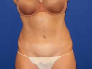 After Image: Abdominoplasty