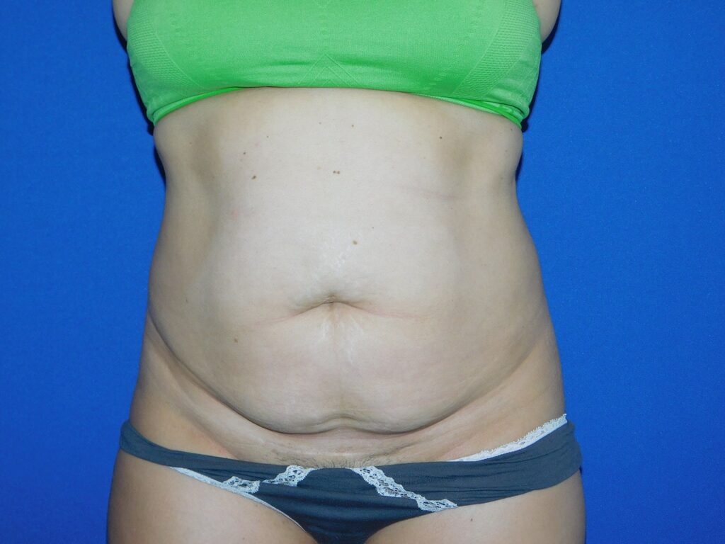 Before Image: Abdominoplasty - front