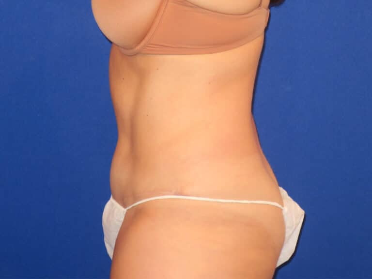 After Image: Abdominoplasty - left-side