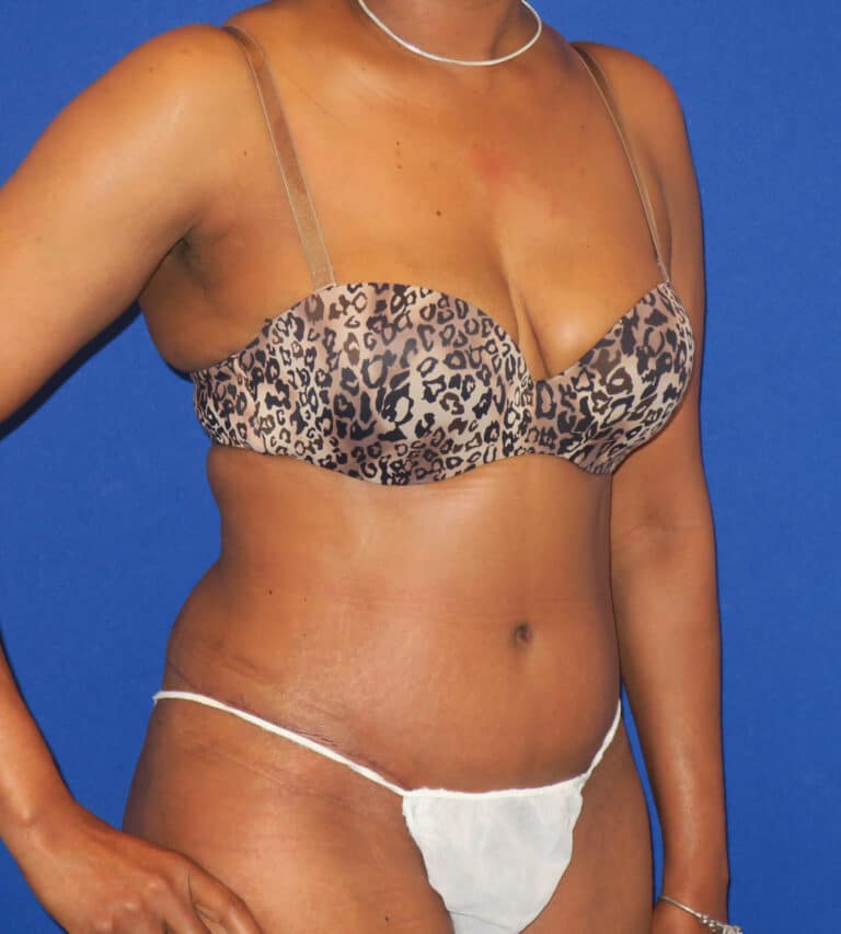 After Image: Abdominoplasty - right-front-oblique