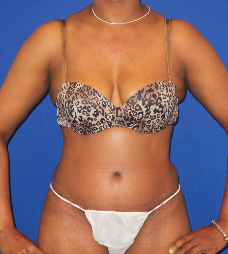 After Image: Abdominoplasty - front