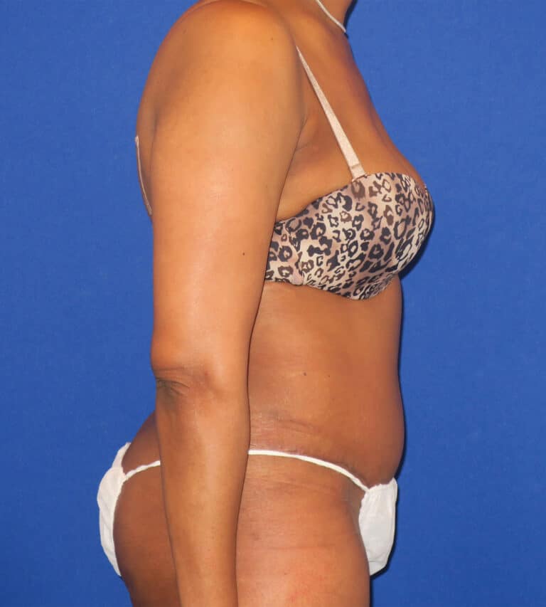 After Image: Abdominoplasty - right-side