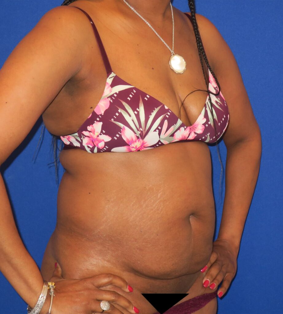 Before Image: Abdominoplasty - right-front-oblique