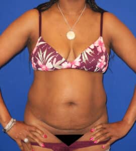 Before Image: Abdominoplasty