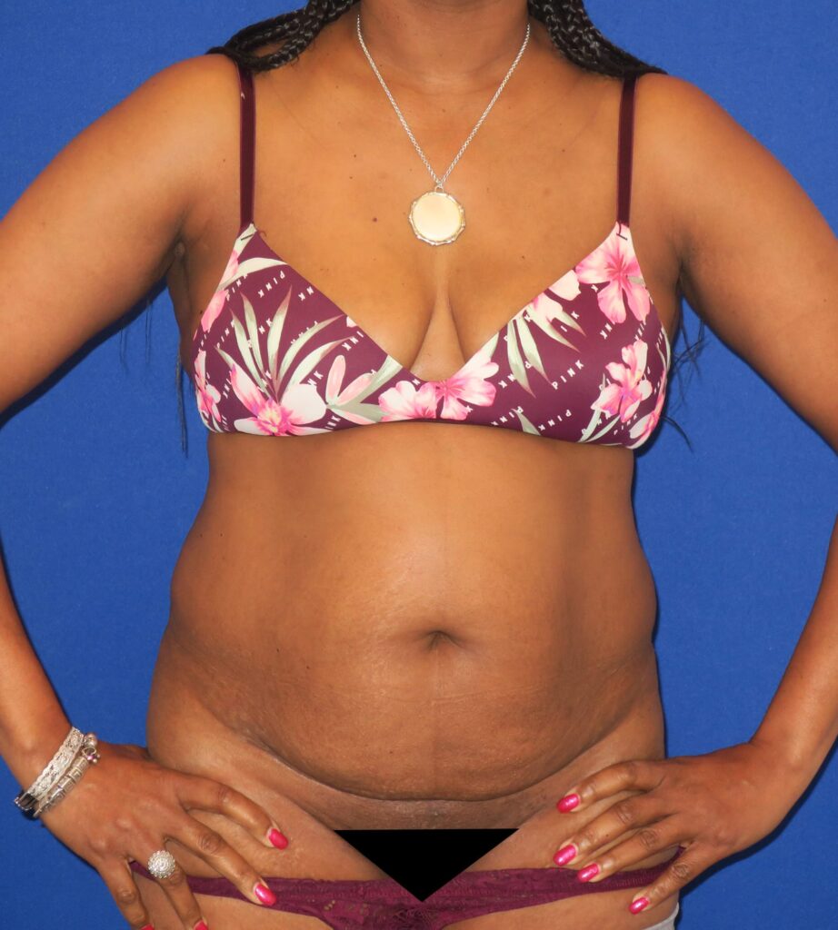 Before Image: Abdominoplasty - front