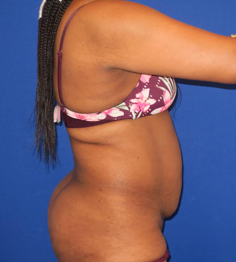 Before Image: Abdominoplasty - right-side