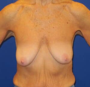 Before Image: Breast Augmentation Mastopexy