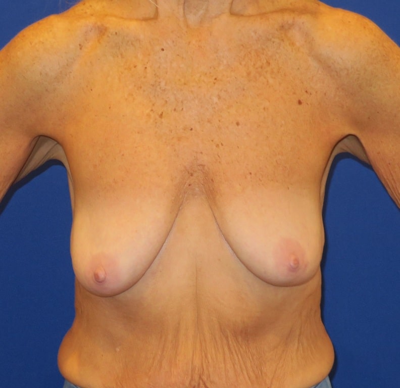 Before Image: Breast Augmentation Mastopexy - front