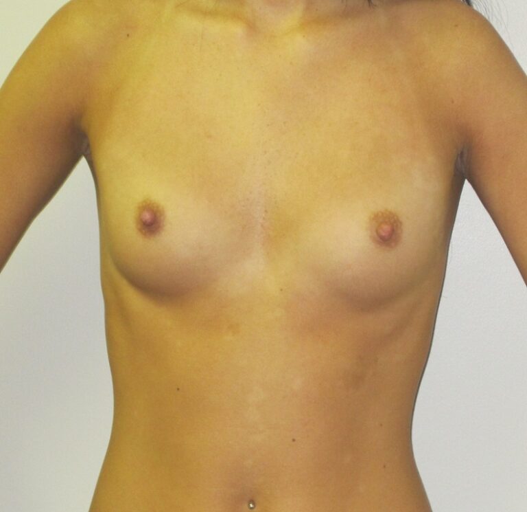 Before Image: Breast Augmentation - front