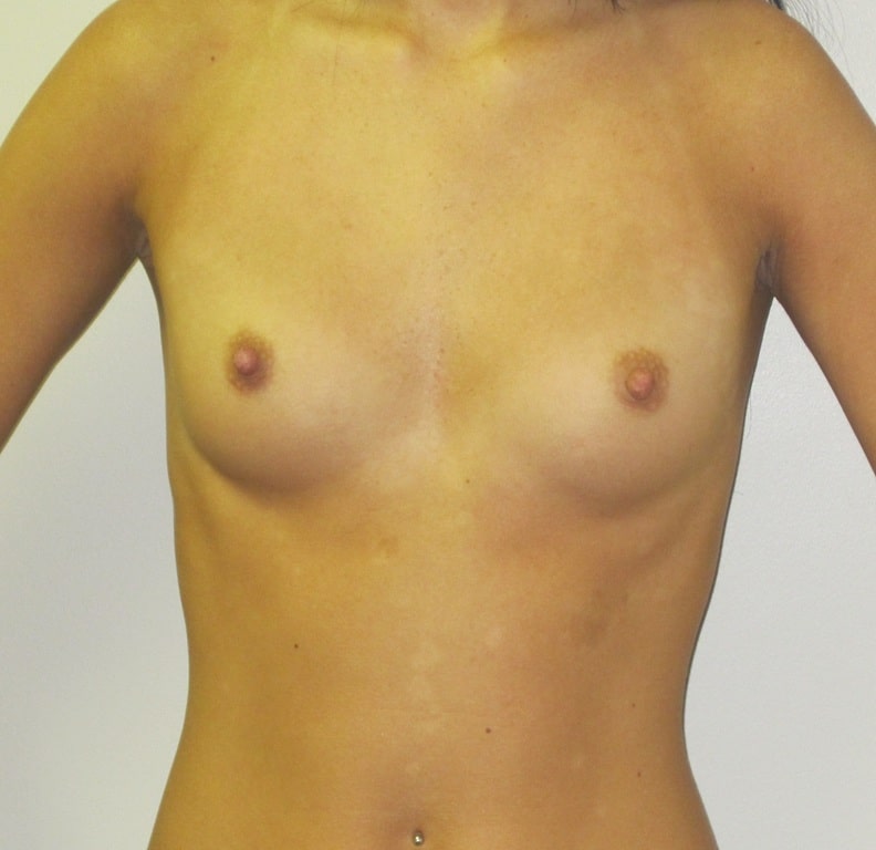 Before Image: Breast Augmentation - front