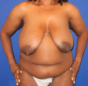 Before Image: Mommy Makeover