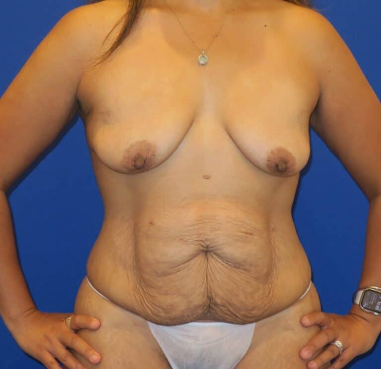 Before Image: Mommy Makeover - front