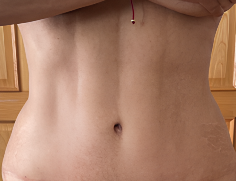 After Image: Abdominal Etching - front