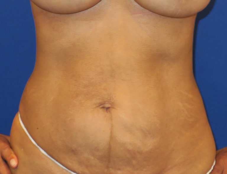 Before Image: Abdominal Etching - front