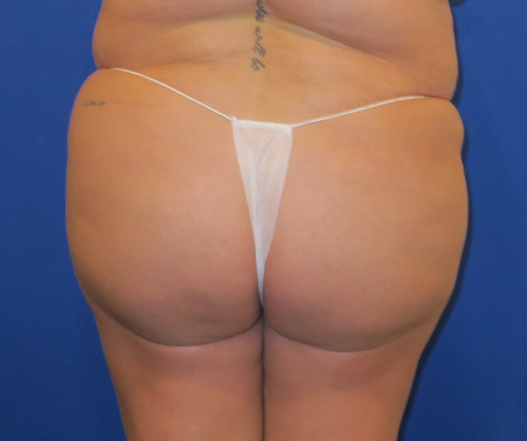 After Image: Brazilian Buttock Lift - front