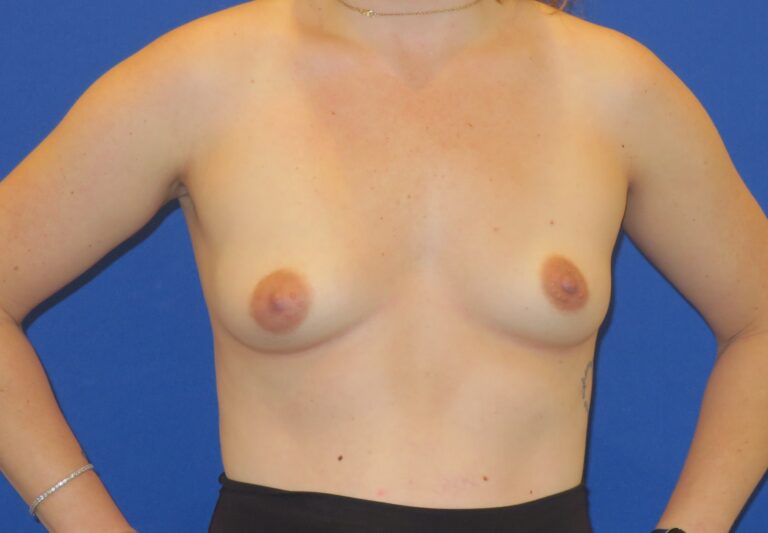 Before Image: Breast Asymmetry - front