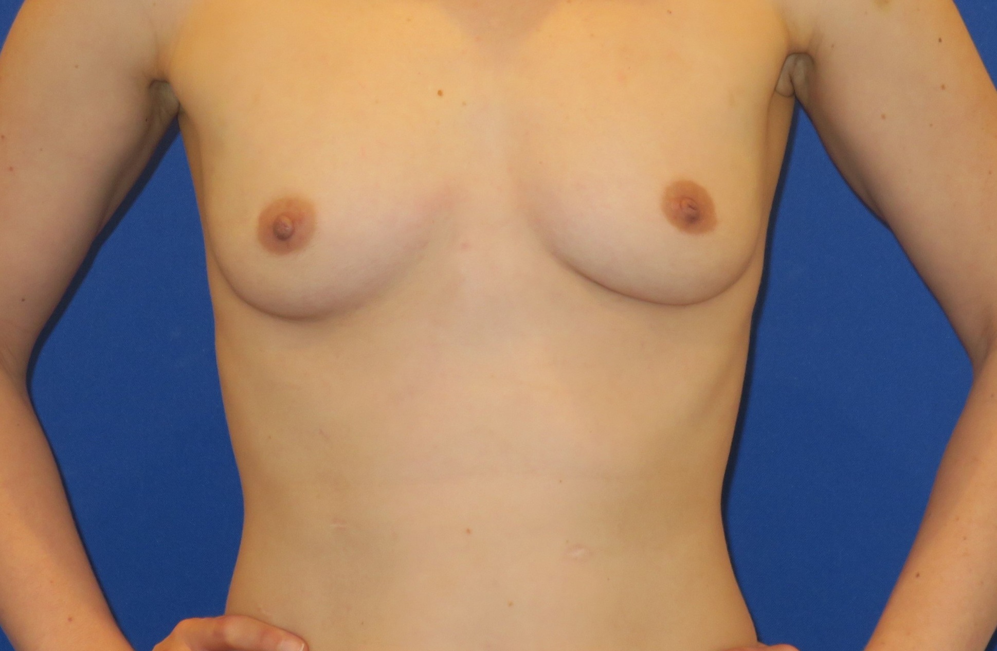 Before Image: Breast Augmentation - front