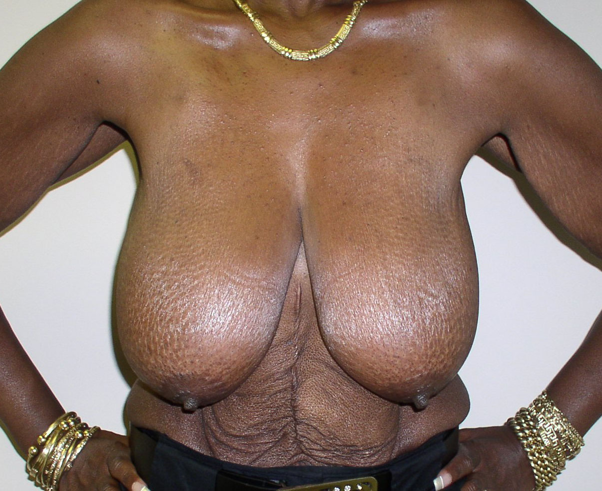Before Image: Breast Lift - front