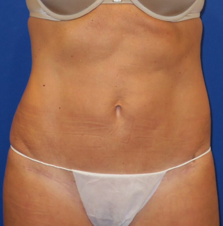 After Image: Mini Tummy Tuck - front