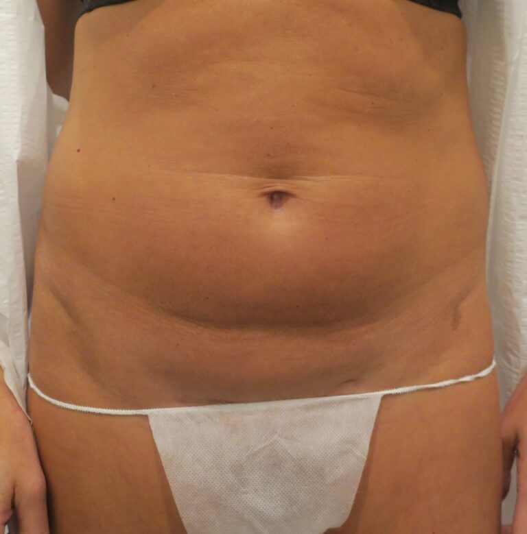 Before Image: Mini Tummy Tuck - front