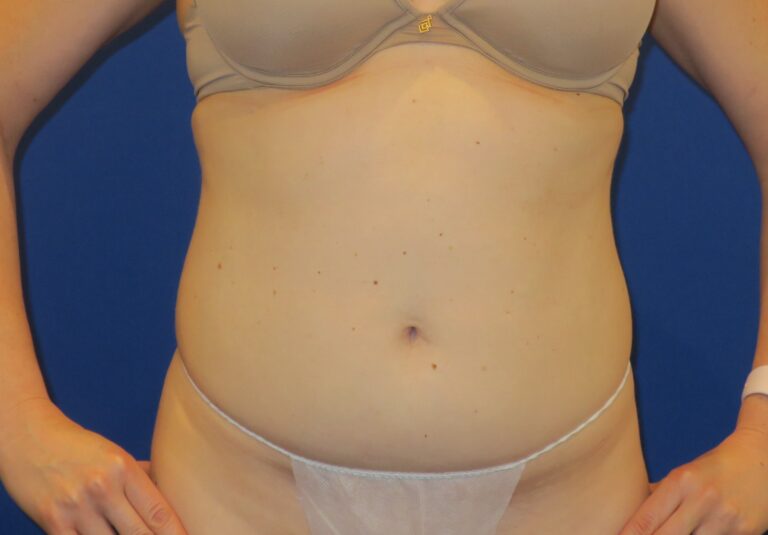 Before Image: Mini Tummy Tuck - front