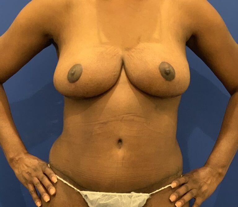 After Image: Mommy Makeover - front