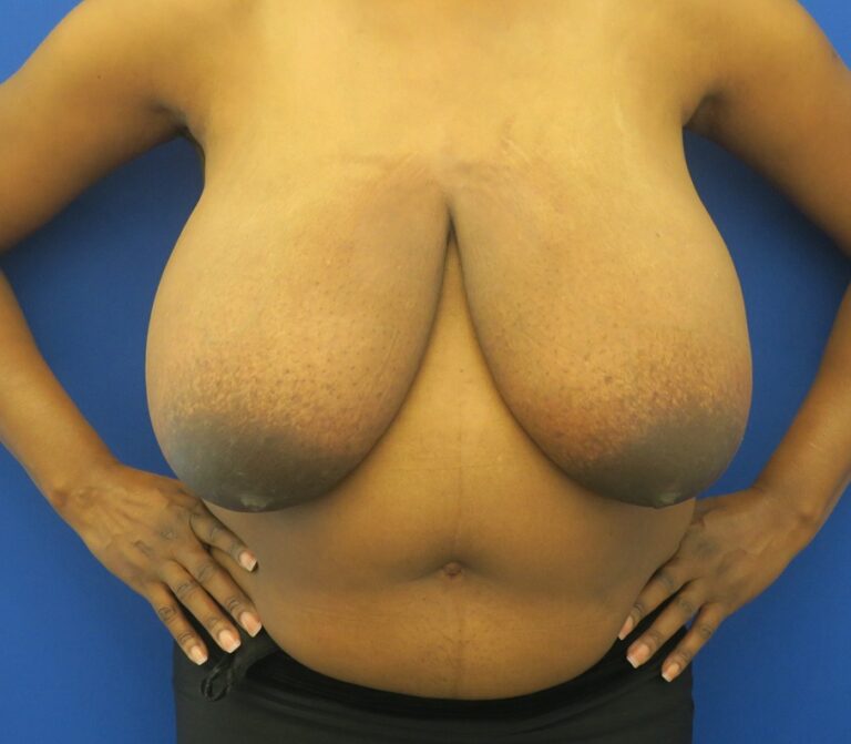 Before Image: Mommy Makeover - front