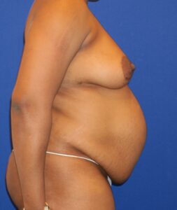 Before Image: Mommy Makeover with Tummy Tuck and Breast Augmentation