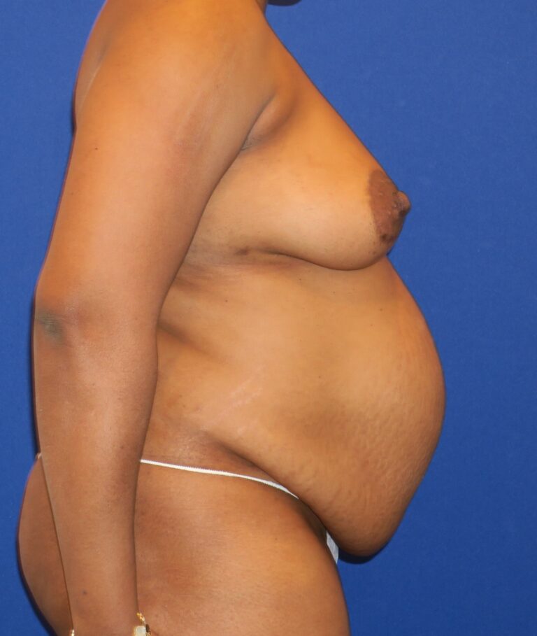 Before Image: Mommy Makeover with Tummy Tuck and Breast Augmentation - right-side