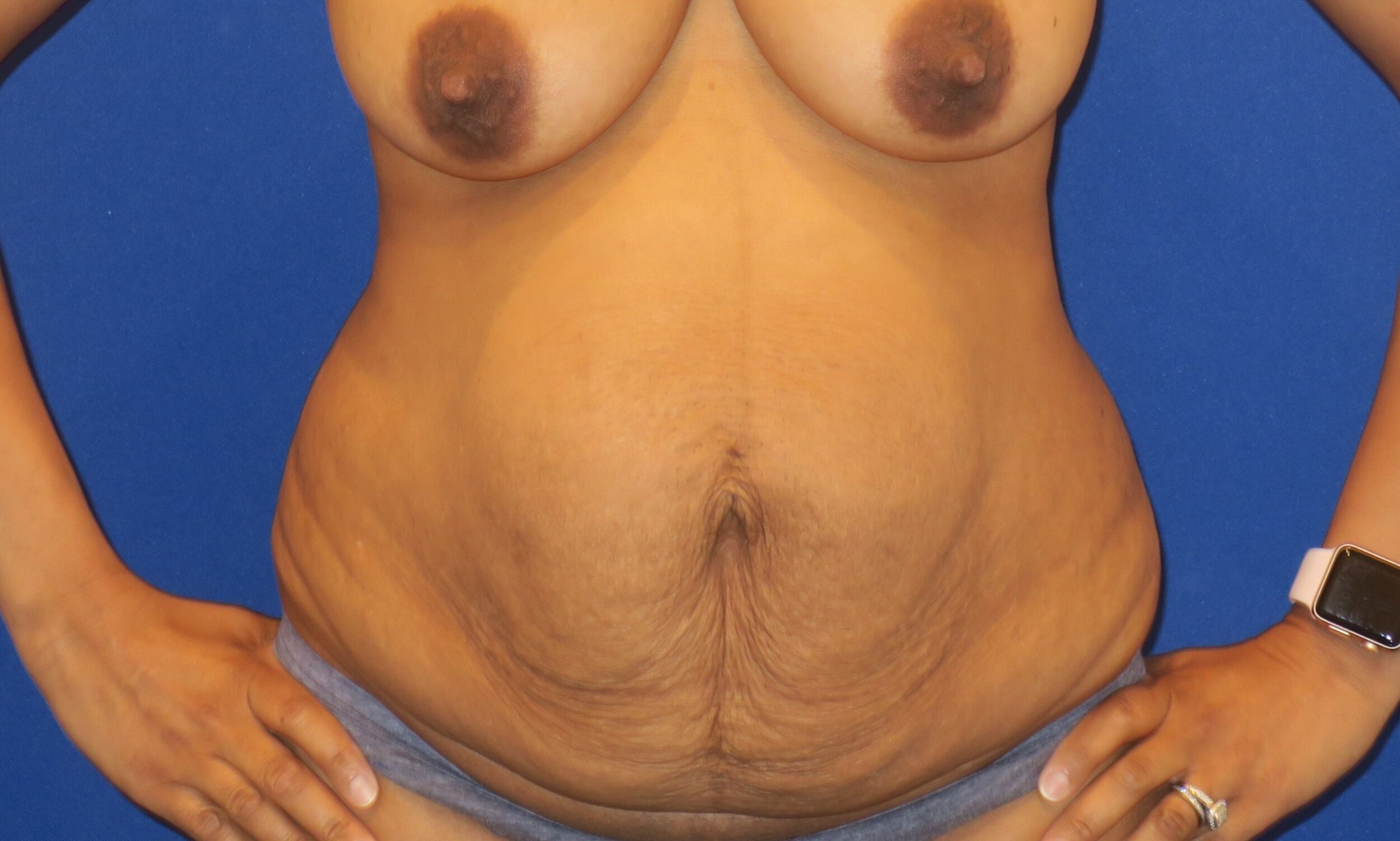 Before Image: Tummy Tuck - front