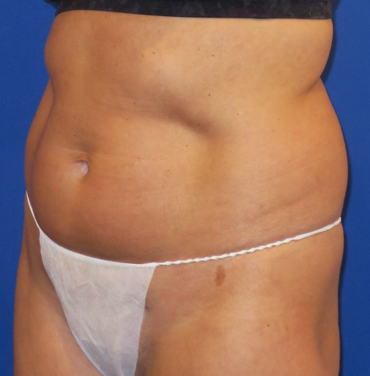 Before Image: Mini Tummy Tuck - left-front-oblique