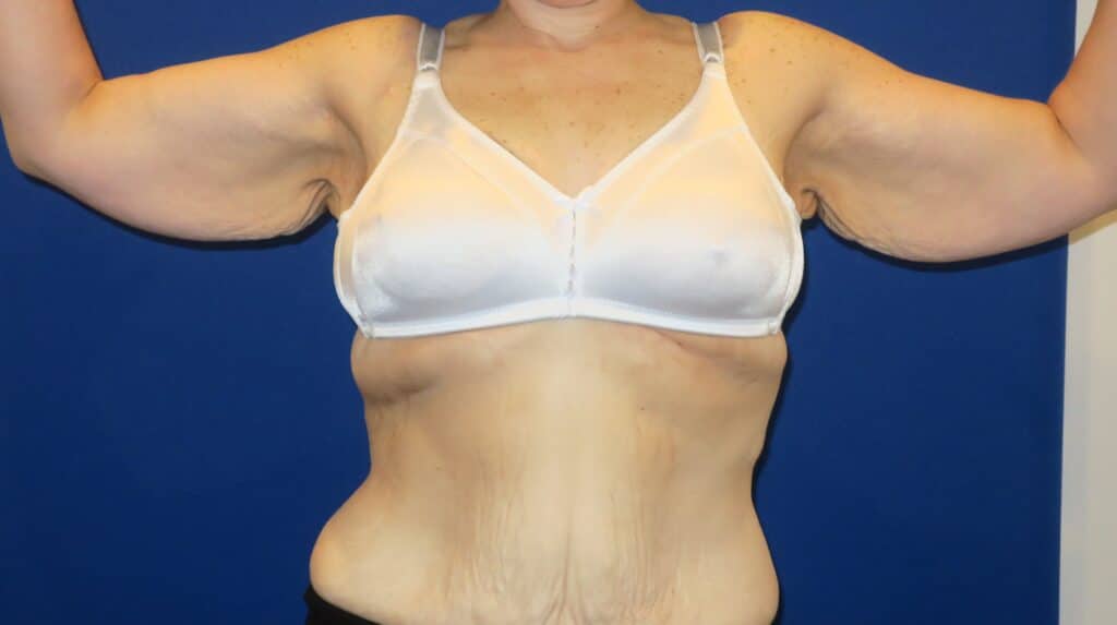 Before Image: Brachioplasty - front
