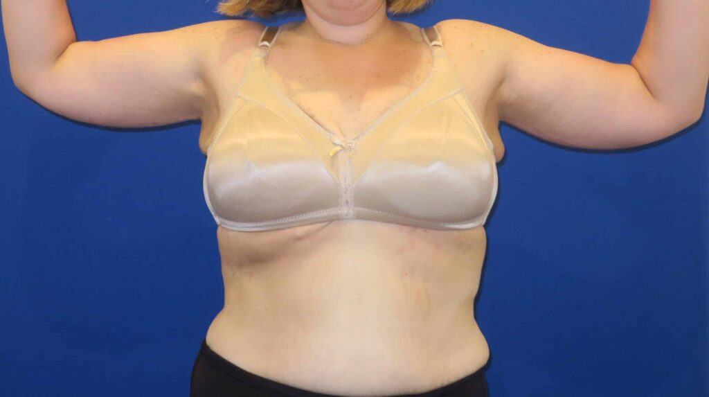 After Image: Brachioplasty - front