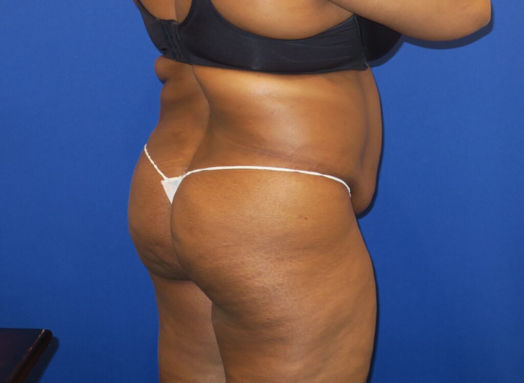 Before Image: Brazilian Buttock Lift - right-back-oblique
