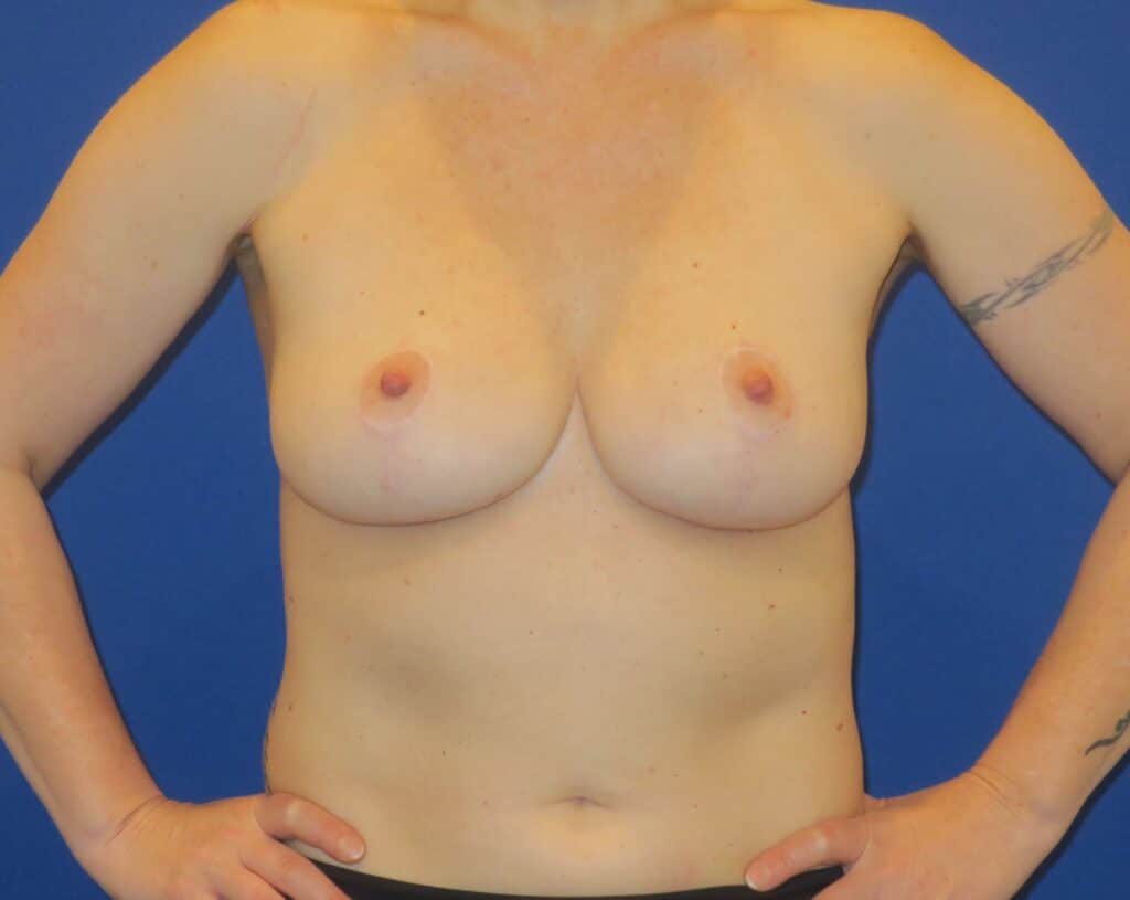 After Image: Breast Reduction - front