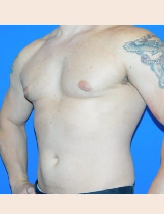 After Image: Male Breast Reduction - front